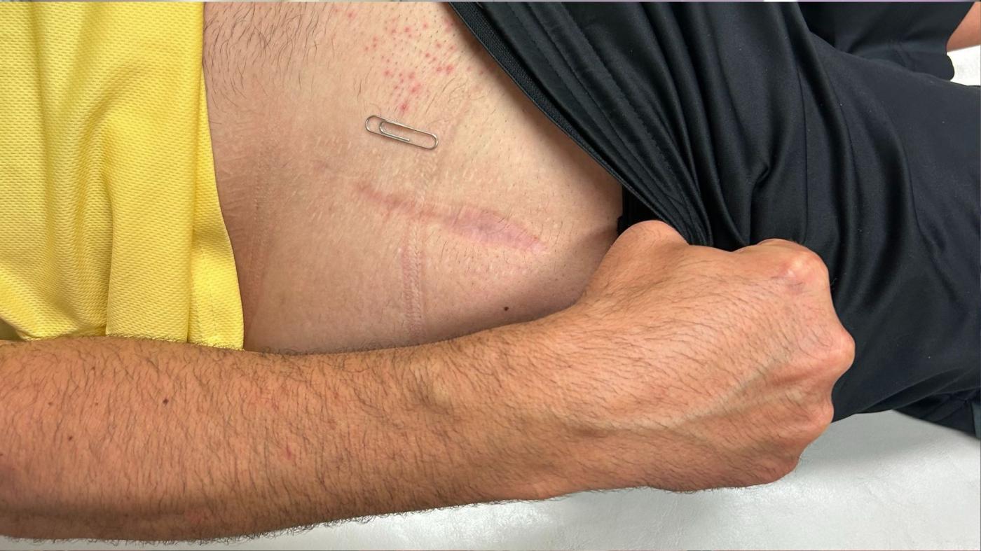 Vithas Valencia Turia incorpora una técnica de vanguardia en cirugía prótesis de cadera