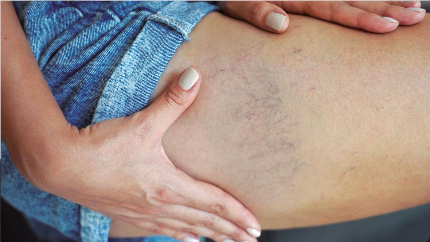 Especialistas de Vithas alertan del aumento de patologías venosas 